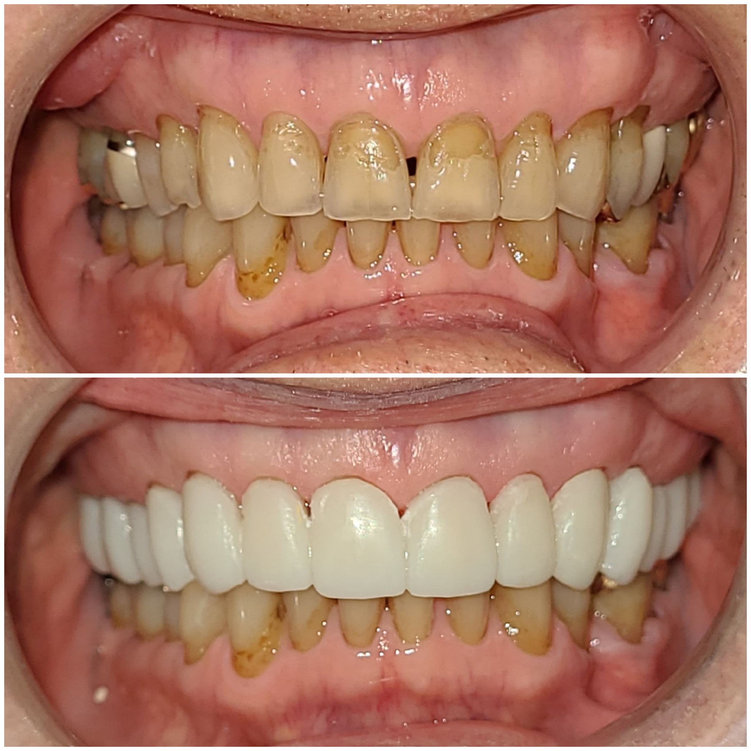 Dental Bridge Dubai